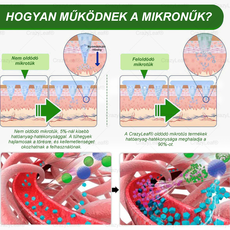 ✅│Hivatalos webáruház│🌿 CrazyLeaf® SMGT-GLP-1 Nano Mikrotűs Tapasz 👉Természetes segítség túlsúly, fáradtság, bőr- és ízületi problémák ellen.